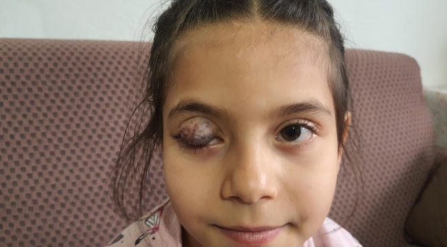 Göz kapağında doğuştan tümör bulunan 7 yaşındaki Beyza'nın yardım çığlığı